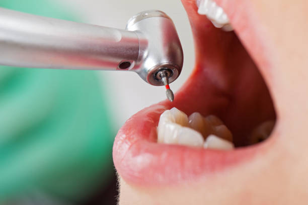 Best Broken or Cracked Tooth Emergency Dentist in Oakville, CT